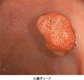 大腸ポリープ