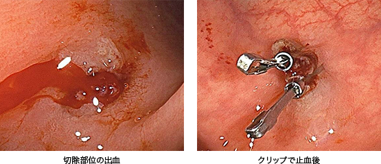 切除部位の出血・クリップで止血後